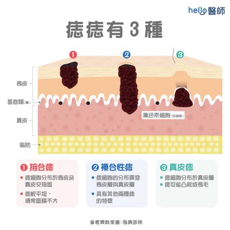 陰莖黑痣|陰莖長黑痣 要找皮膚科｜性福教戰｜性愛｜元氣